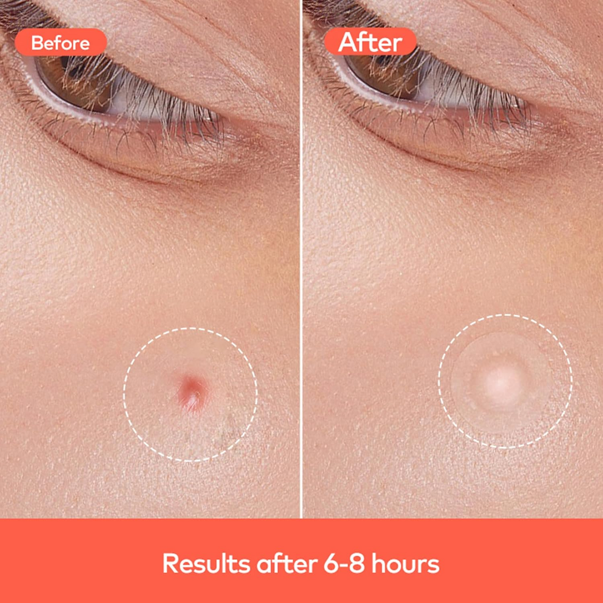 Pimple Patches for Face (1 Sheet Set)